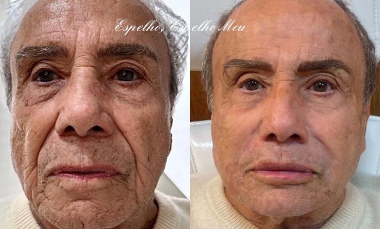 Após polêmica com harmonização facial de Stênio Garcia, Rodrigo César explica procedimentos estéticos na terceira idade